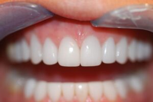 Veneers After Only 300x201