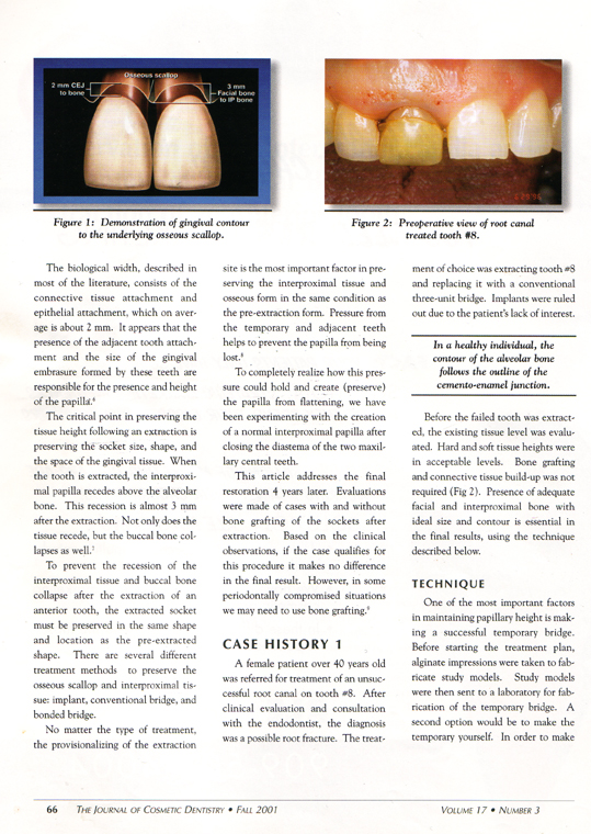 Preservation Of The Interdental Papilla 2
