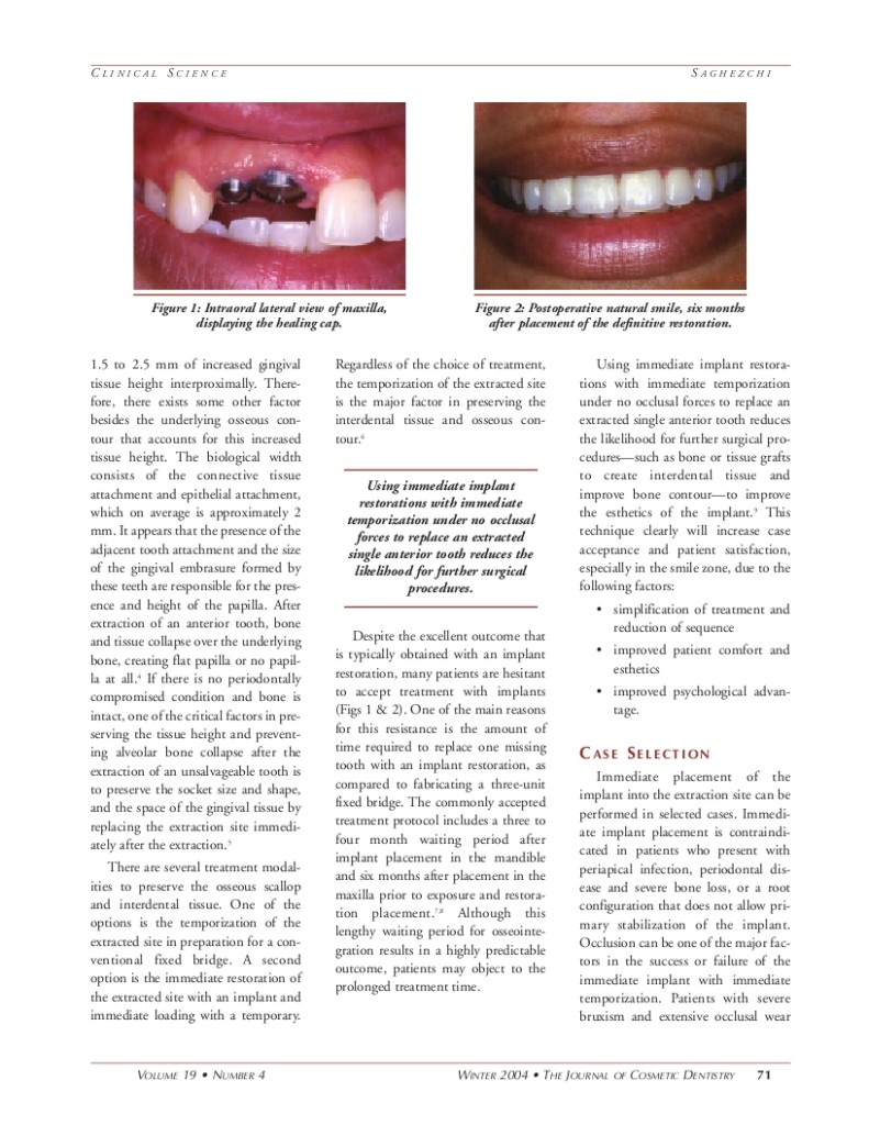 Replacing A Single Tooth 2